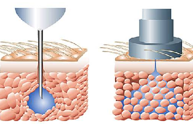 Needle-free injection system; the MS Pulse250